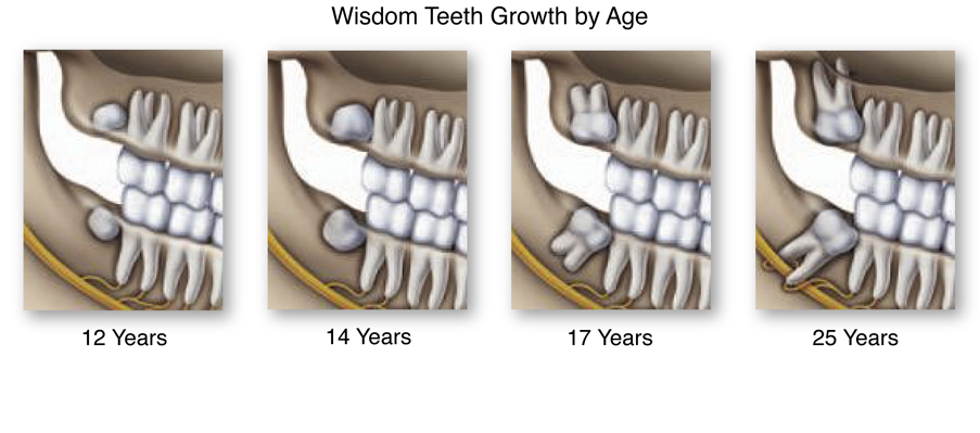 All about Wisdom Teeth Removal Pain